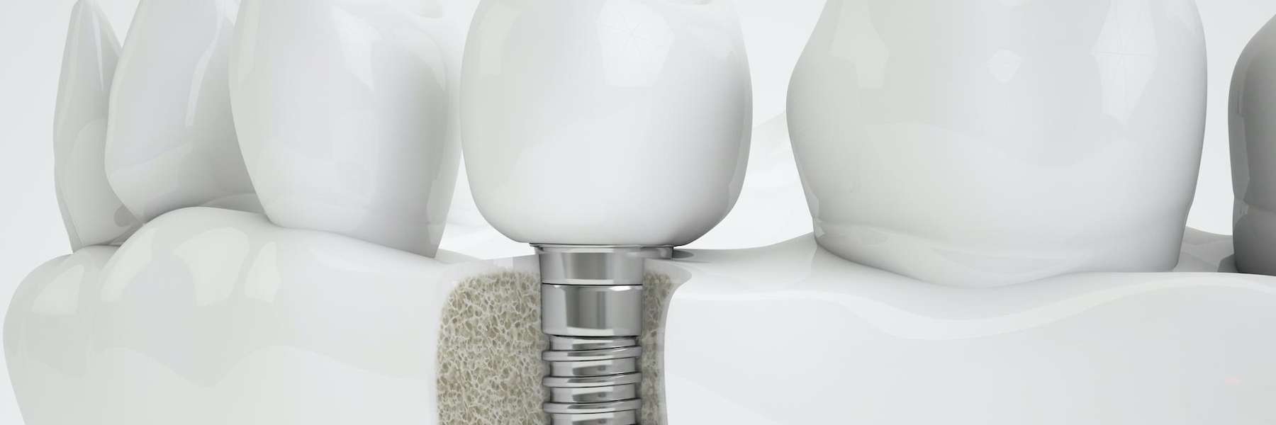 Experience the Difference at Platte Valley Dental Care: Our Comprehensive Services